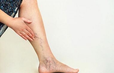 Kaip gydyti apatinių galūnių varikozės venas