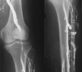 Galūnių varikozinių venų diagnostikos galimybės