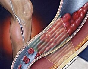 apatinių galūnių giliųjų venų varikozė